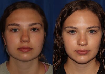 Front View Chin Implant & Liposuction before and after photo by Dr. Wick featured