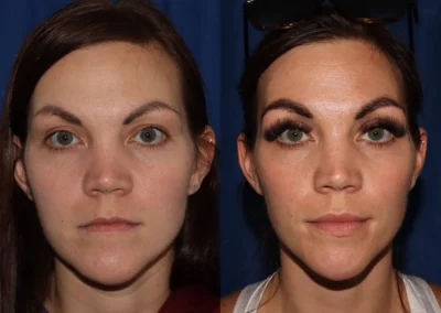 Front View Eyebrow Hair Restoration before and after photo by Dr. Wick