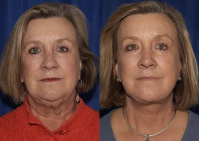 Front View Multilift before and after photo by Dr. Wick