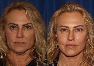 Front View Multilift before and after photo by Dr. Wick featured