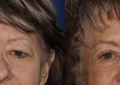 Front View Upper Eyelid Surgery before and after photo by Dr. Wick